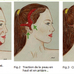 Lifting du visage après une perte excessive de poids