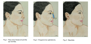 rhinoplastie