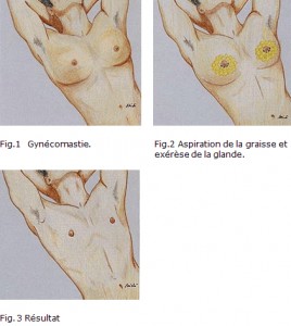 chirurgie-reduction-sein-homme