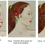 Lifting du visage vs minilifting