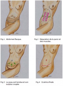 lifting-ventre-maroc abdominoplastie maroc