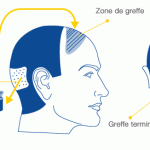 Historique de la greffe des cheveux par Dr.  Rhounim Taha Elidrissi