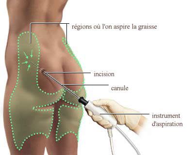 lipofilling fesses