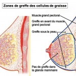 Augmentation mammaire par la lipofilling (transplantation de graisse)