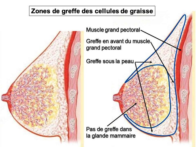 lipofilling seins Maroc