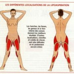 liposuccion lipoaspiration