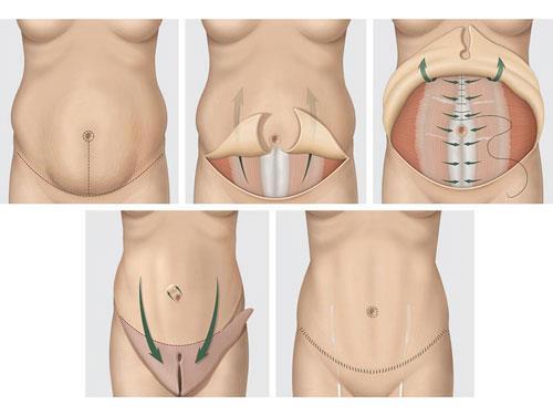 chirurgie abdominoplastie explication