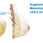 Nouvelle  Tendance  pour  l’augmentation mammaire:  Le LIPOFILLING