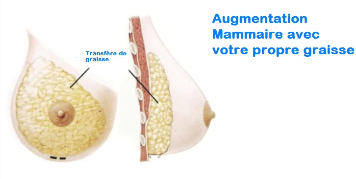 augmentation mammaire grasse, lipofilling