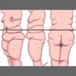 Body lift ou belt lipectomy Par Dr. Taha  Rhounim  Elidrissi
