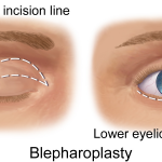 La blépharoplastie où Chirurgie esthétique des paupières par Dr. Taha Rhounim  Elidrissi