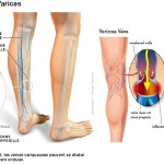 Varice et varicosité est-ce qu’il y a une différence entre les deux ?