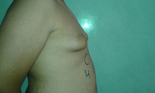 image poitrine droit avant operation gynecomastie