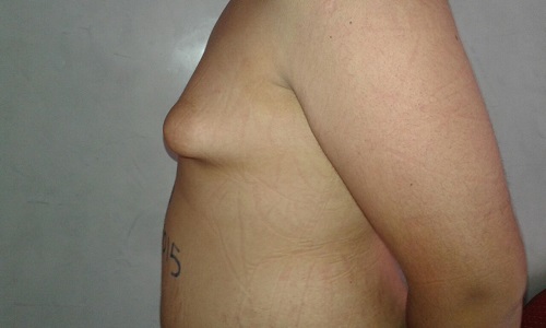 image poitrine gauche avant intervention gynecomastie
