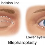 Conseils pour éviter une chirurgie des paupières ratées