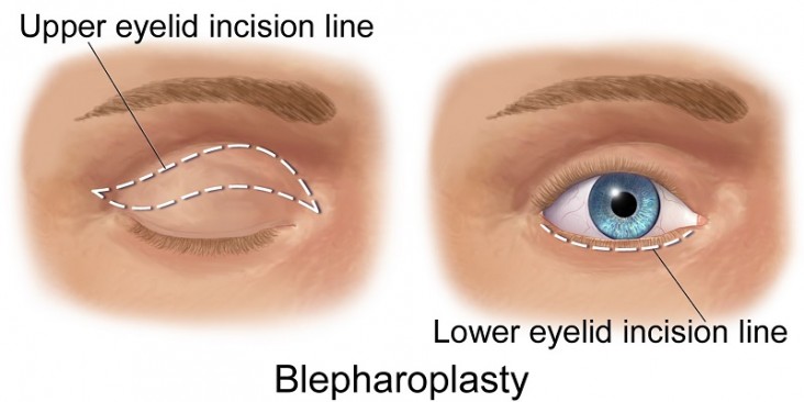 blépharoplastie chirurgie des paupières