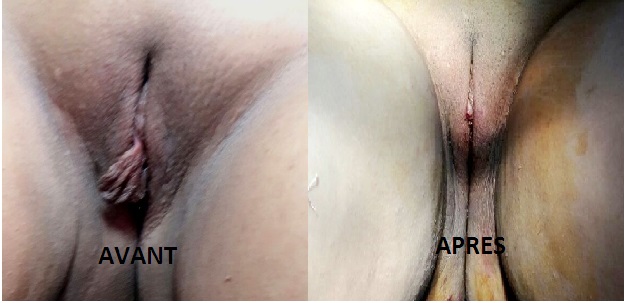 Avant et après la nymphoplastie
