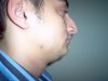 rhinoplastie