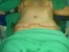 photo-de-patiente-aprs-le-lifting-des-seins-lifting-du-sex-et-abdominoplastie