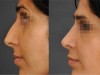 rhinoplastie